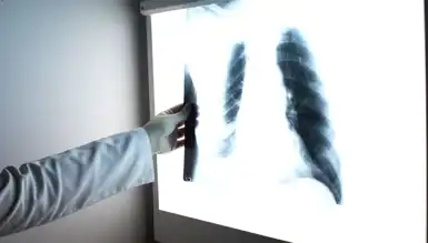 Sigara İçmeyenlerde Akciğer Kanseri Artışı!