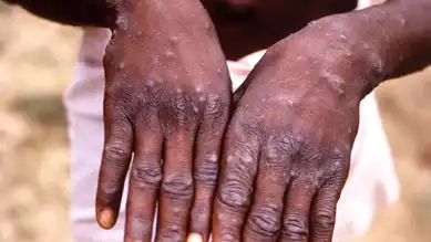 Afrika Ülkesinde Binlerce Yeni Maymun Çiçeği Vakası